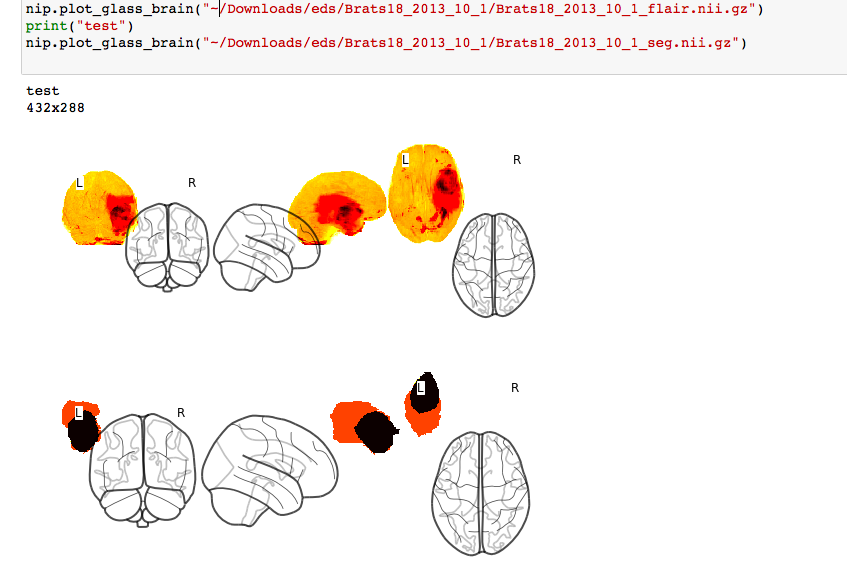 Developmental loss of NMDA receptors results in