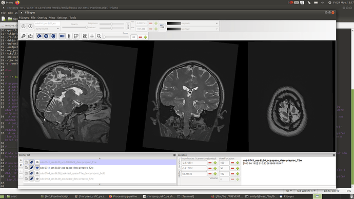 Brain Artifacts