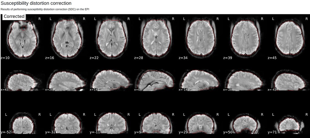 Fmaps, Phase Encoding Direction, and Distortion Correction - Neurostars