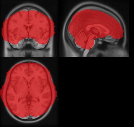 MRICron misalignment, 50%