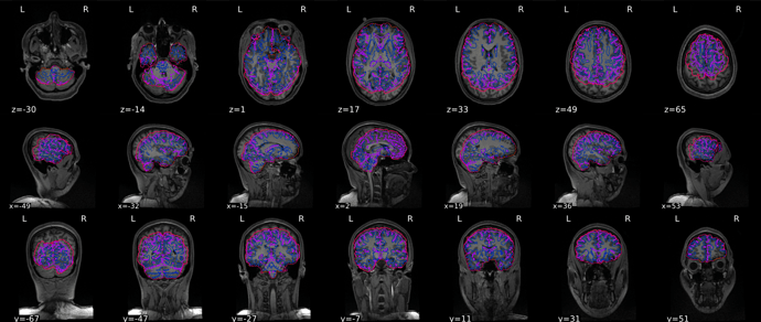 sub-01_T1w_seg_brainmask_01