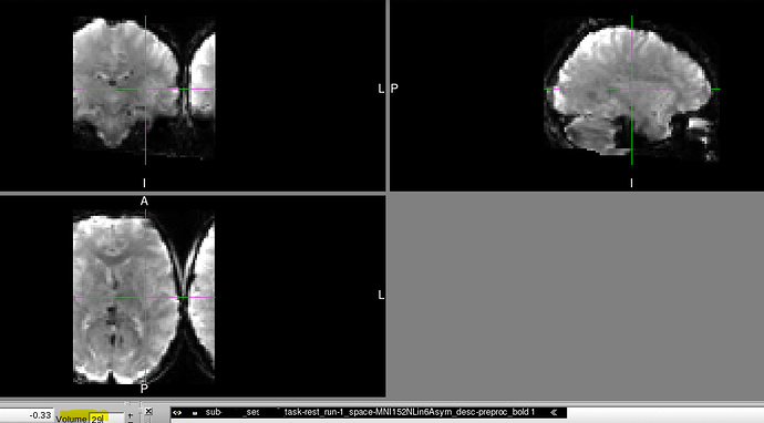 Case1_MNI_timecourse_mid