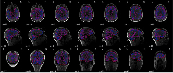 T1-segmentation