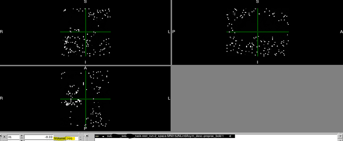 Case2_MNI_timecourse_end