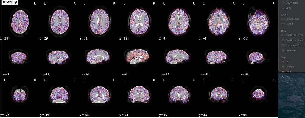 Fmriprep Spatial Normalization Of Functional Images Gone Wrong Fmriprep Spatial Normalization Of Functional Images Gone Wrong