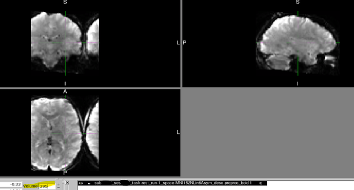 Case1_MNI_timecourse_end