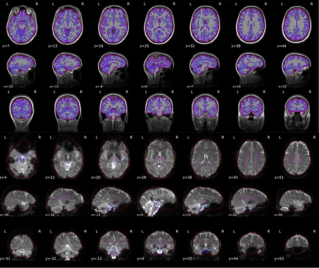 Brain Mask In Python BOLD Brain Mask too wide besides T1 Brain Mask being fine - Software ...