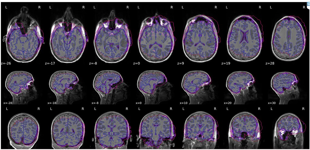 fMRIPrep Normalization failed in a problematic subject - Software ...