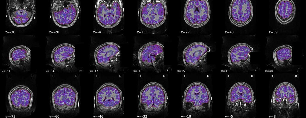 fMRIPrep: Brain extraction (and therefore spatial normalization) failed ...