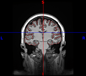 sub-CMH0029_desc-CoronalCaudateAmygdala_T1w
