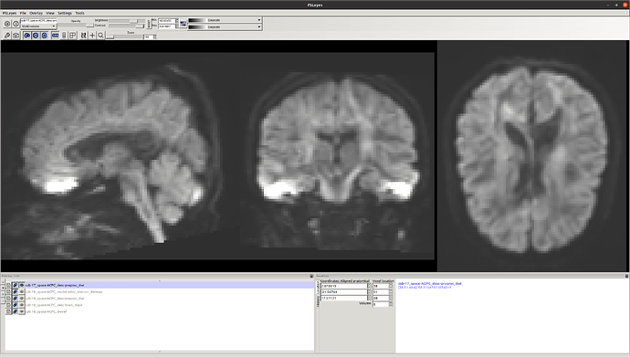 dwi hyperintensities