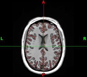 sub-CMH0029_desc-AxialBasalGangliaPutamen_T1w