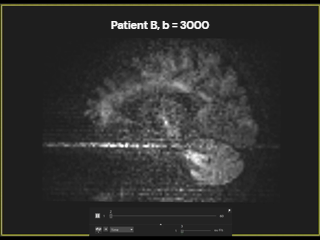 noise_amplification_patient_B_b3000_seq