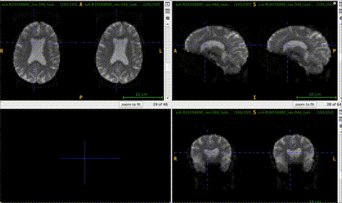 for_neurostar