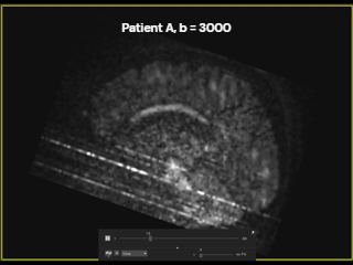 noise_amplification_patient_A_b3000_seq